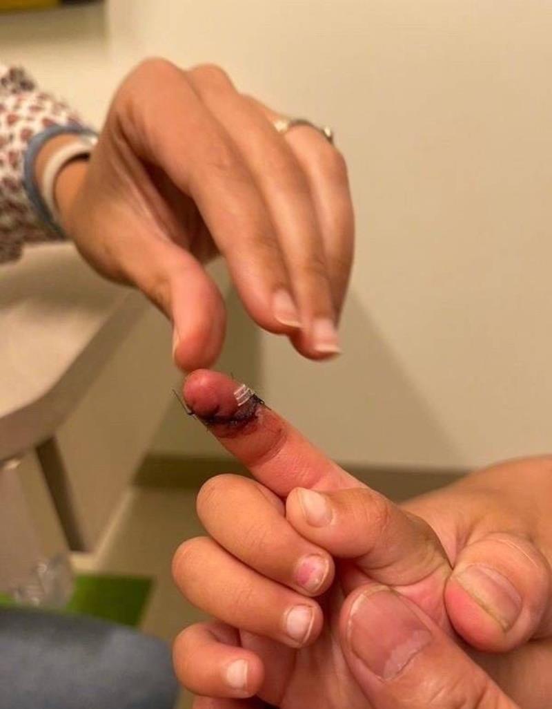 郑爽被前夫张恒指控虐童 女儿见完妈妈后手指惊见6cm缝针伤痕