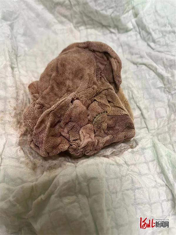 女子生产后两块纱布被遗留体内